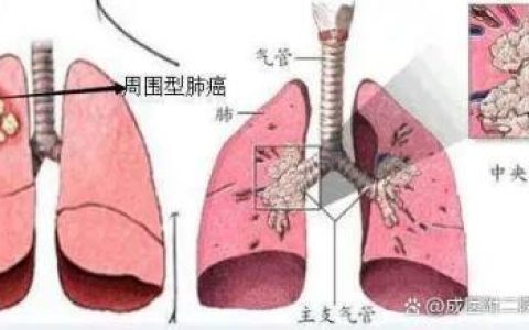 确诊肺癌，需要做哪些检查？-肺癌确诊都需要做什么检查