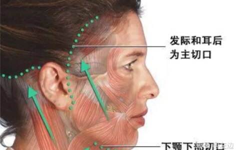 筋膜提升术是什么、筋膜提升拉皮手术维持多久-筋膜提拉手法