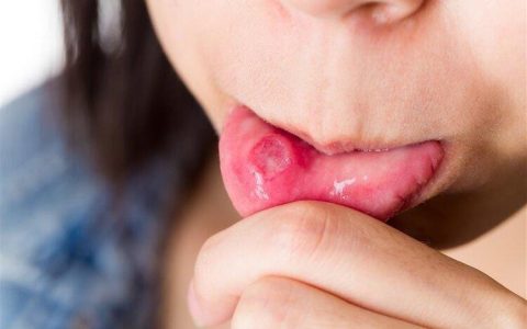 有一种剧痛叫“口腔溃疡”，补充维C不管用，3种方法更有效-口腔溃疡吃什么样的维生素好