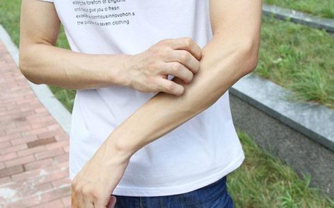 成都升温千足虫满街爬！春夏季蚊虫过敏后，该如何治？-成都夏天有什么