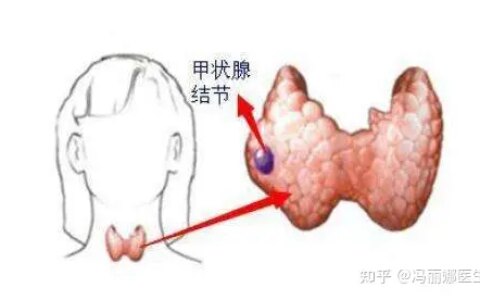 甲状腺结节如何调理比较好？中医医师：这么做有利于散结！-调理甲状腺结节的中药方子